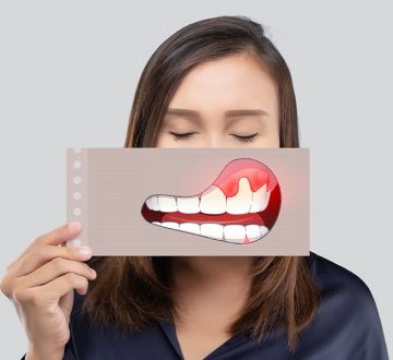 How Do You Cure Gum Disease Without Surgery?
