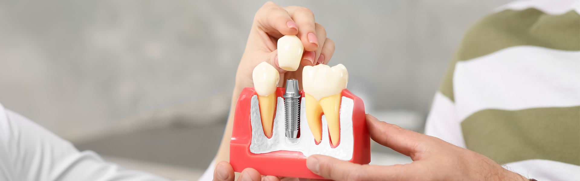 Learn More About Dental Implants Before And After